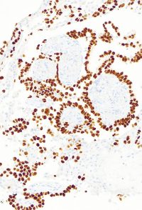 IHC_TTF_Lung_AdenoCa_5